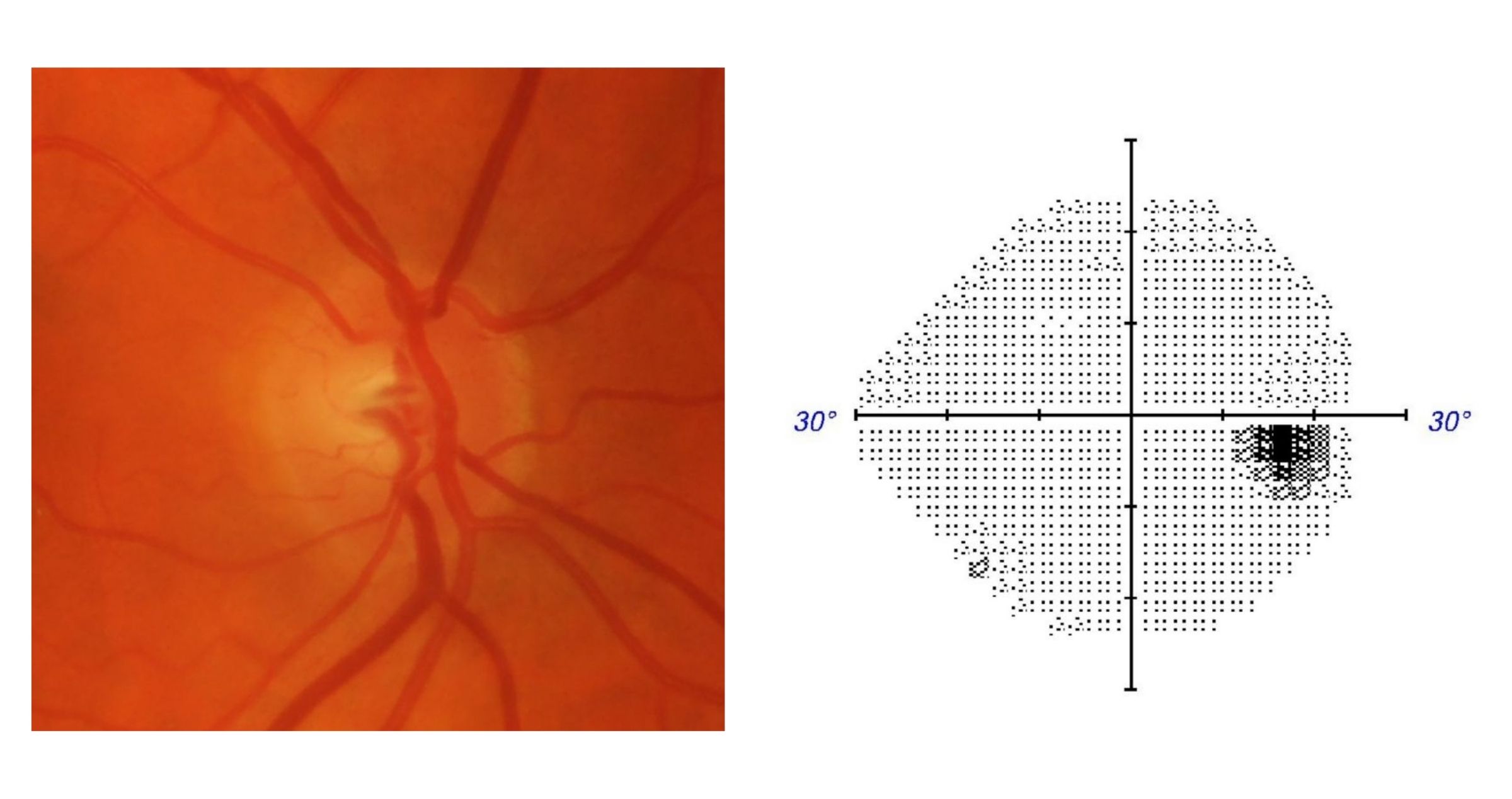 glaucoma-eye-test-chart